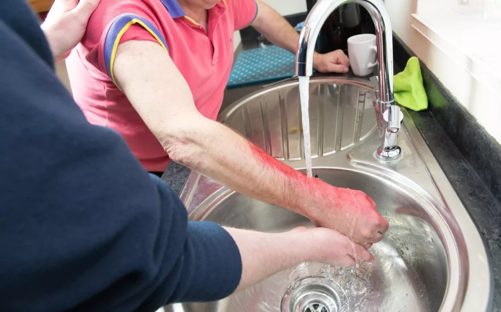 Une personne passe une brûlure sous l'eau pendant une formation SST initiale et recyclage